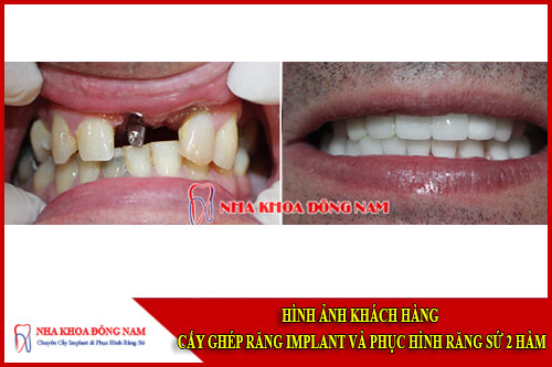 Hình ảnh khách hàng phục hình răng implant và phục hình răng sư