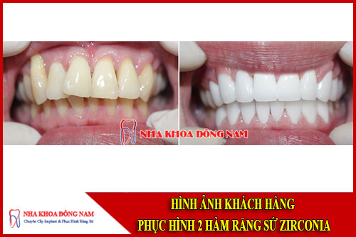 Hình ảnh khách hàng phục hình răng toàn sứ Zirconia