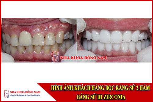 Hình ảnh khách hàng phục hình răng toàn sứ Hi-Zirconia