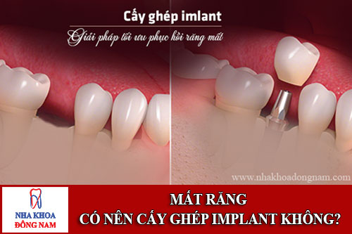 mất răng có nên cấy ghép implant không?
