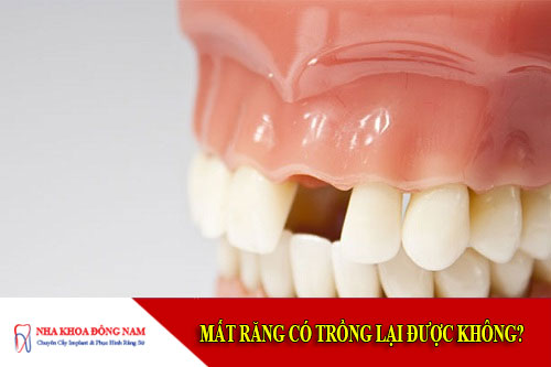 Mất răng có trồng lại được không