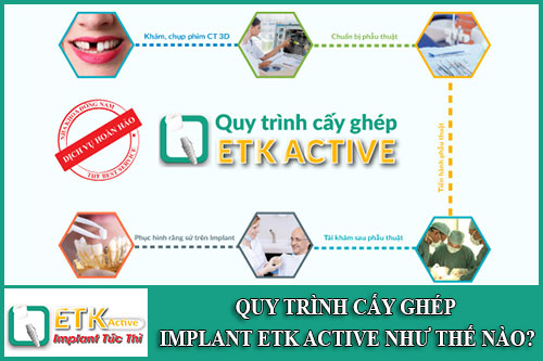 quy trình cấy ghép implant etk active như thế nào