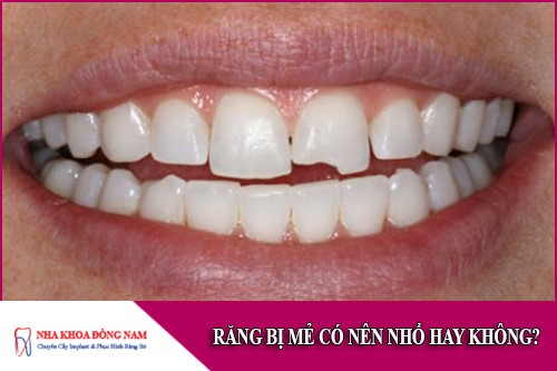 răng bị mẻ có nên nhổ hay không