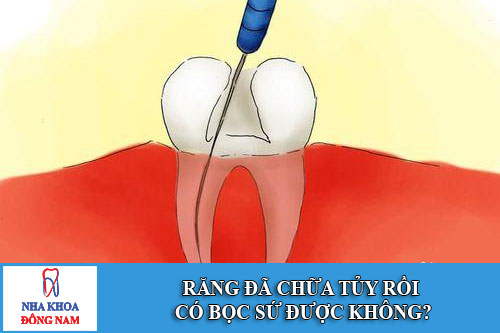 răng đã chữa tủy rồi có bọc sứ được không