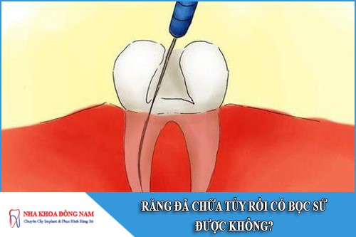răng đã chữa tủy rồi có bọc sứ được không