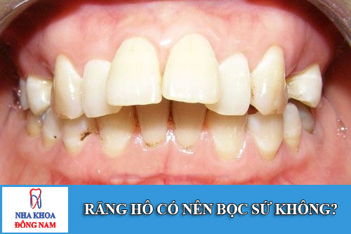 Răng hô có nên bọc sứ không