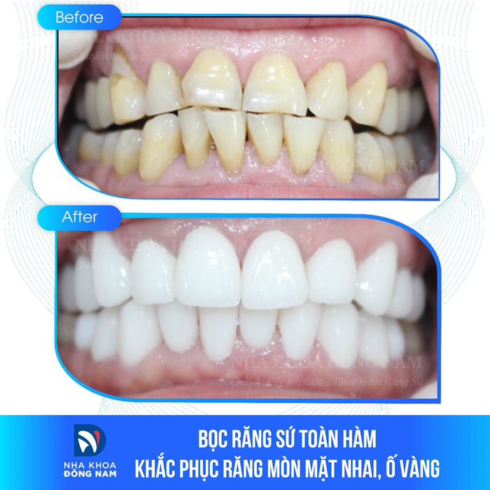 Bọc răng sứ khắc phục răng mòn mặt nhai