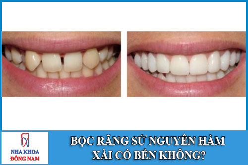 Bọc răng sứ nguyên hàm xài có bền không