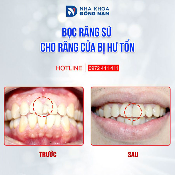 Bọc răng sứ phục hình răng bị hư tổn