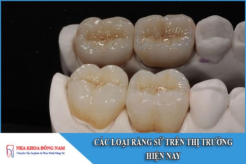 các loại răng sứ trên thì trường hiện nay