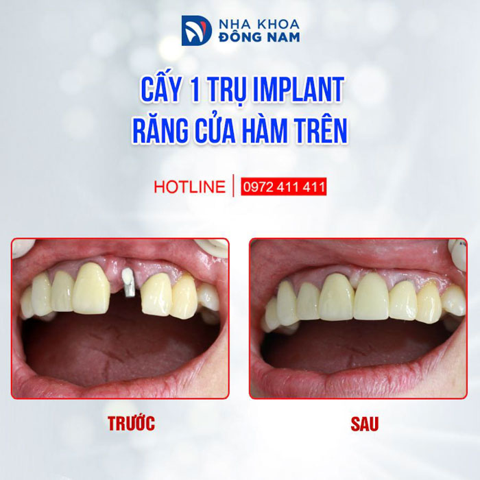 Cấy ghép Implant giúp phục hình răng mất tốt nhất hiện nay