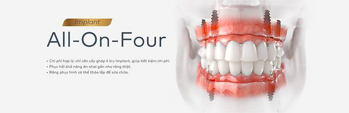 Implant All On 4 mang lại nhiều ưu điểm