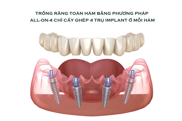 Kỹ thuật cấy ghép Implant All On 4 là giải pháp tối ưu khi mất răng toàn hàm