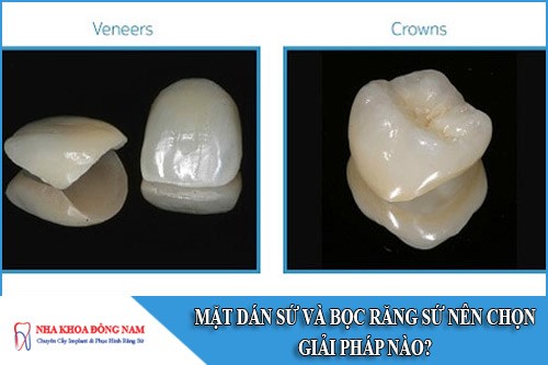 mặt dán sứ và bọc răng sứ nên chọn giải pháp nào