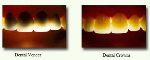 Mặt Dán Sứ Và Bọc Răng
