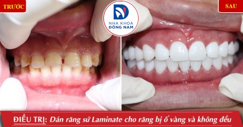 dán răng sứ laminate