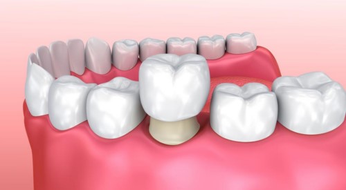 mô phỏng kỹ thuật bọc răng sứ
