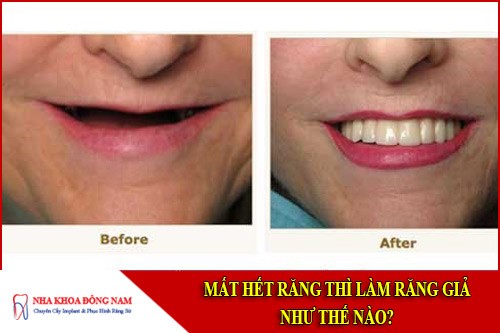 mất hết răng thì làm răng giả như thế nào