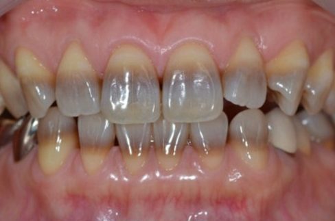 men răng là gì? cách phục hồi lại men răng bằng nhiều phương pháp 5