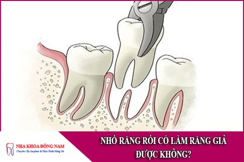 nhổ răng rồi có làm răng giả được không