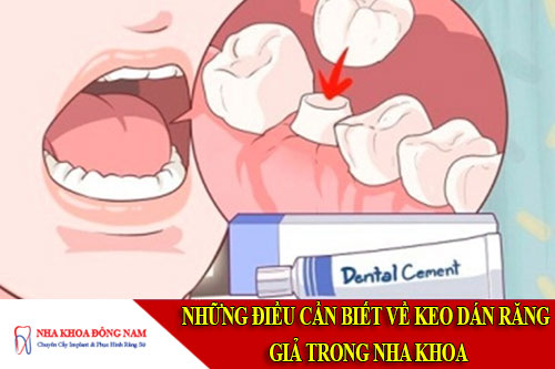 Những điều cần biết về keo dán răng giả trong nha khoa