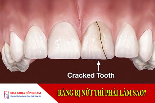 Răng bị nứt thì phải làm sao