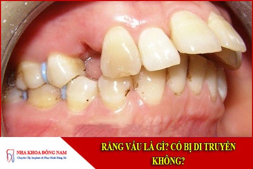 răng vẩu là gì? có bị di truyền không