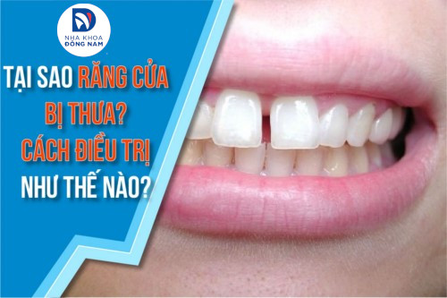 tại sao răng cửa bị thưa? cách điều trị như thế nào