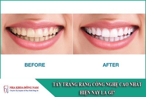 Tẩy trắng răng công nghệ cao