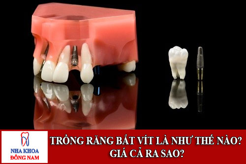 Trồng răng bắt vít là như thế nào