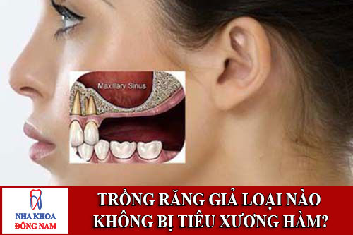 Trồng răng giả loại nào không bị tiêu xương hàm
