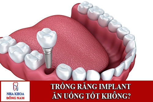 Trồng răng Implant ăn uống tốt không