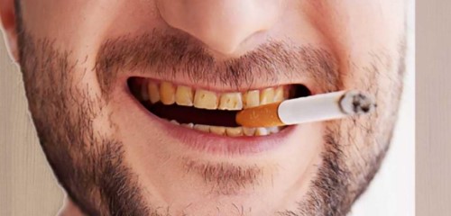 hút thuốc lá gây vàng răng