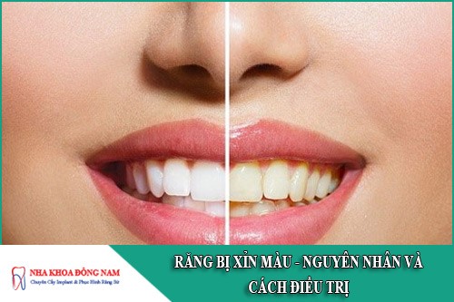 vì sao răng bị xỉn màu