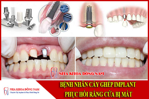 cấy ghép implant phục hồi răng cửa bị mất