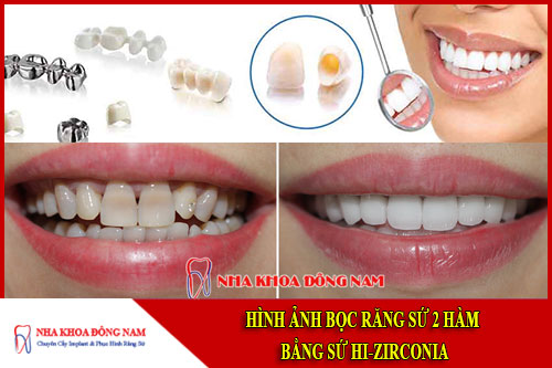 hình ảnh bọc răng sứ 2 hàm bằng sứ hi-zirconia