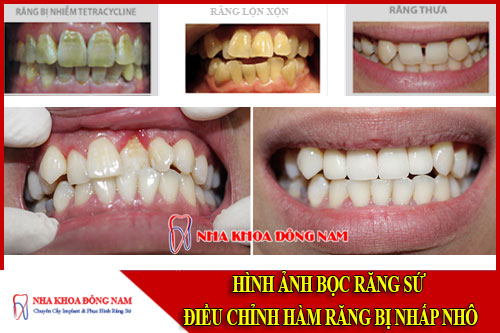hình ảnh bọc răng sứ điều chỉnh hàm răng bị nhấp nhô