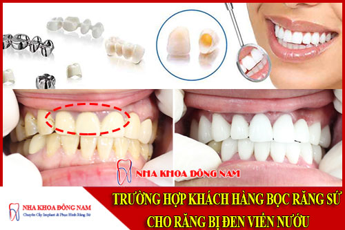 trường hợp khách hàng bọc răng sứ cho răng bị đen viền nướu