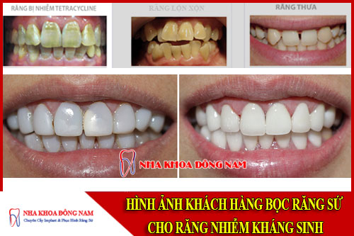 bọc răng sứ cho răng nhiễm kháng sinh