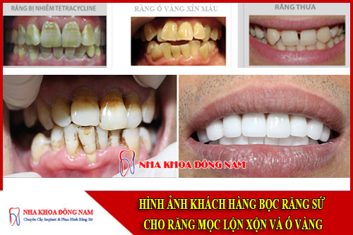 bọc răng sứ cho răng mọc lộn xộn và ố vàng