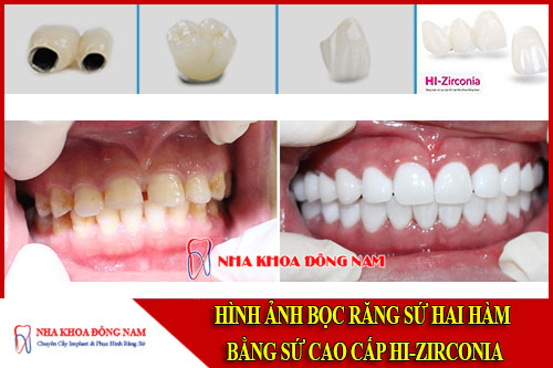 bọc răng sứ hai hàm bằng sứ cao cấp hi-zirconia