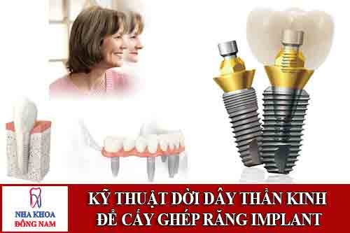 kỹ thuật dời dây thần kinh để cấy ghép răng implant