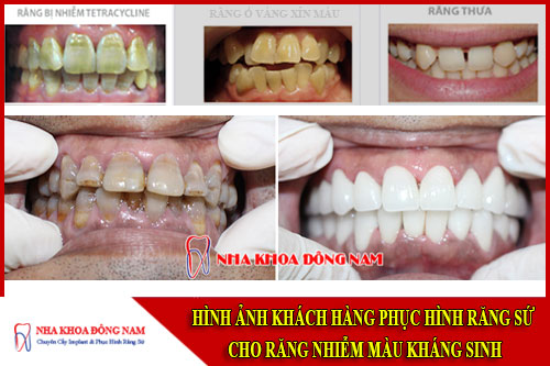 phục hình răng sứ cho răng nhiễm màu kháng sinh