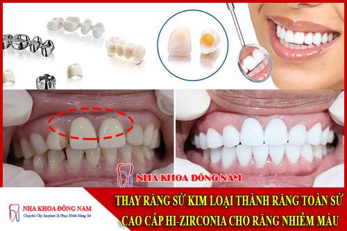 thay răng sứ kim loại thành răng toàn sứ cao cấp hi-zirconia cho răng nhiễm màu