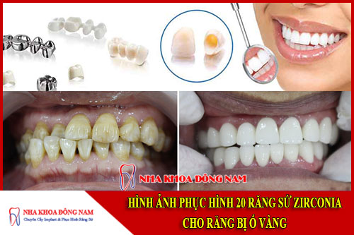 hình ảnh phục hình 20 răng sứ zirconia cho răng bị ố vàng
