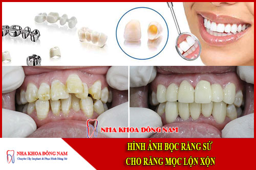 bọc răng sứ cho răng mọc lộn xộn