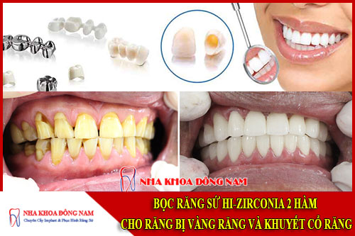 bọc răng sứ hi-zirconia 2 hàm cho răng bị vàng răng và khuyết cổ răng