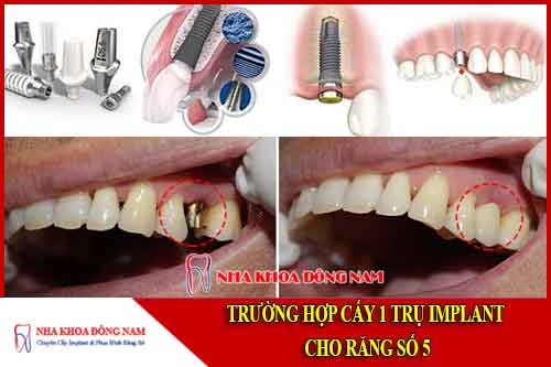 hình ảnh cấy 1 trụ implant cho răng số 5