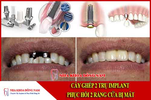 cấy ghép 2 trụ implant phục hồi 2 răng cửa bị mất