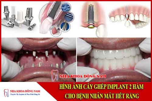 cấy ghép implant 2 hàm cho bệnh nhân mất hết răng